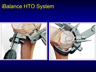 iBalanceiBalance HTO SystemHTO System
 