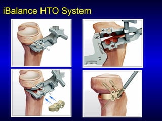 iBalanceiBalance HTO SystemHTO System
 