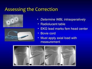 Assessing the CorrectionAssessing the Correction
• Determine WBL intraoperativelyDetermine WBL intraoperatively
• Radiolucent tableRadiolucent table
• EKG lead marks fem head centerEKG lead marks fem head center
• Bovie cordBovie cord
• Must apply axial load withMust apply axial load with
measurementmeasurement
 