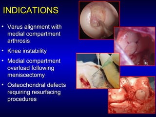 INDICATIONSINDICATIONS
• Varus alignment withVarus alignment with
medial compartmentmedial compartment
arthrosisarthrosis
• Knee instabilityKnee instability
• Medial compartmentMedial compartment
overload followingoverload following
meniscectomymeniscectomy
• Osteochondral defectsOsteochondral defects
requiring resurfacingrequiring resurfacing
proceduresprocedures
 