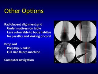 Other OptionsOther Options
Radiolucent alignment grid
Under mattress on table
Less vulnerable to body habitus
No parallax and kinking of cord
Drop rod
Prep hip -> ankle
Full size fluoro machine
Computer navigation
 