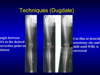 Techniques (Dugdale)Techniques (Dugdale)
Angle between
MA to the desired
correction point on
plateau
Cut film at desired
osteotomy site and
shift until WBL is
corrected
 