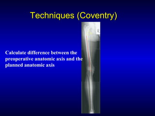 Techniques (Coventry)Techniques (Coventry)
Calculate difference between the
preoperative anatomic axis and the
planned anatomic axis
 