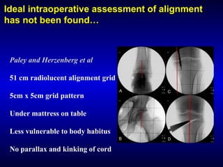 Ideal intraoperative assessment of alignmentIdeal intraoperative assessment of alignment
has not been found…has not been found…
Paley and Herzenberg et al
51 cm radiolucent alignment grid
5cm x 5cm grid pattern
Under mattress on table
Less vulnerable to body habitus
No parallax and kinking of cord
 