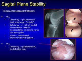 Sagital Plane StabilitySagital Plane Stability
Primary Anteroposterior StabilizersPrimary Anteroposterior Stabilizers
 ACLACL
• DeficiencyDeficiency →→ posteromedialposteromedial
tibial-sided wear (“tibial-sided wear (“cupulacupula””))
• DeficiencyDeficiency →→ ↑↑ risk of medialrisk of medial
meniscal tear, need formeniscal tear, need for
meniscectomy, worsening varusmeniscectomy, worsening varus
(viscious cycle)(viscious cycle)
• IntactIntact →→ more typicalmore typical
anteromedial wear patternanteromedial wear pattern
 PCLPCL
• DeficiencyDeficiency →→ patellofemoral,patellofemoral,
medial sided wearmedial sided wear
 