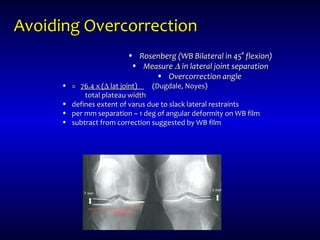 Avoiding OvercorrectionAvoiding Overcorrection
• Rosenberg (WB Bilateral in 45Rosenberg (WB Bilateral in 45° flexion)° flexion)
• MeasureMeasure ∆∆ in lateral joint separationin lateral joint separation
• Overcorrection angleOvercorrection angle
• == 76.4 x (76.4 x (∆∆ lat joint)lat joint) (Dugdale, Noyes)(Dugdale, Noyes)
total plateau widthtotal plateau width
• defines extent of varus due to slack lateral restraintsdefines extent of varus due to slack lateral restraints
• per mm separation ~ 1 deg of angular deformity on WB filmper mm separation ~ 1 deg of angular deformity on WB film
• subtract from correction suggested by WB filmsubtract from correction suggested by WB film
 