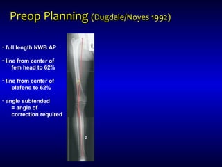 Preop PlanningPreop Planning (Dugdale/Noyes 1992)(Dugdale/Noyes 1992)
• full length NWB AP
• line from center of
fem head to 62%
• line from center of
plafond to 62%
• angle subtended
= angle of
correction required
 