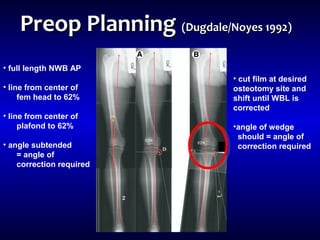 • full length NWB AP
• line from center of
fem head to 62%
• line from center of
plafond to 62%
• angle subtended
= angle of
correction required
• cut film at desired
osteotomy site and
shift until WBL is
corrected
•angle of wedge
should = angle of
correction required
Preop PlanningPreop Planning (Dugdale/Noyes 1992)(Dugdale/Noyes 1992)
 