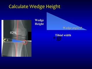 Calculate Wedge HeightCalculate Wedge Height
•ØØ
Tibial width
Wedge
Height
Wedge angle ØWedge angle Ø
 
