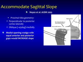 Accommodate Sagittal Slope
• Proximal tibia geometry:
• Perpendicular to posterior
cortex laterally
• Oblique (~45deg) medially
Noyes et al. AJSM 2005
Medial opening wedge with
equal anterior and posterior
gaps would INCREASE slope
 