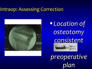 Intraop: Assessing CorrectionIntraop: Assessing Correction
•Location ofLocation of
osteotomyosteotomy
consistentconsistent
withwith
preoperativepreoperative
planplan
 