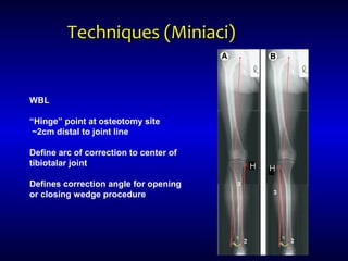 Techniques (Miniaci)Techniques (Miniaci)
WBL
“Hinge” point at osteotomy site
~2cm distal to joint line
Define arc of correction to center of
tibiotalar joint
Defines correction angle for opening
or closing wedge procedure
 