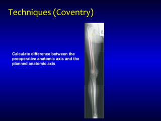 Techniques (Coventry)Techniques (Coventry)
Calculate difference between the
preoperative anatomic axis and the
planned anatomic axis
 