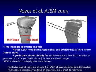 Noyes et al, AJSM 2005Noyes et al, AJSM 2005
•Three triangle geometric analysis
Places Keith needles in anteromedial and posteromedial joint line to
assess slope
2 guide pins placed distally for medial osteotomy line (from anterior to
posterior) must be perpendicular to joint line to maintain slope
•With a standard metaphyseal osteotomy…
•Anterior gap at tubercle should be HALF of gap at posteromedial cortex
•Advocates triangular wedges of bicortical iliac crest to maintain
Incr Slope Dec Slope
 