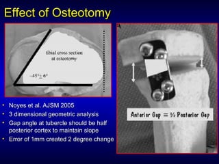 Effect of OsteotomyEffect of Osteotomy
• Noyes et al. AJSM 2005Noyes et al. AJSM 2005
• 3 dimensional geometric analysis3 dimensional geometric analysis
• Gap angle at tubercle should be halfGap angle at tubercle should be half
posterior cortex to maintain slopeposterior cortex to maintain slope
• Error of 1mm created 2 degree changeError of 1mm created 2 degree change
 