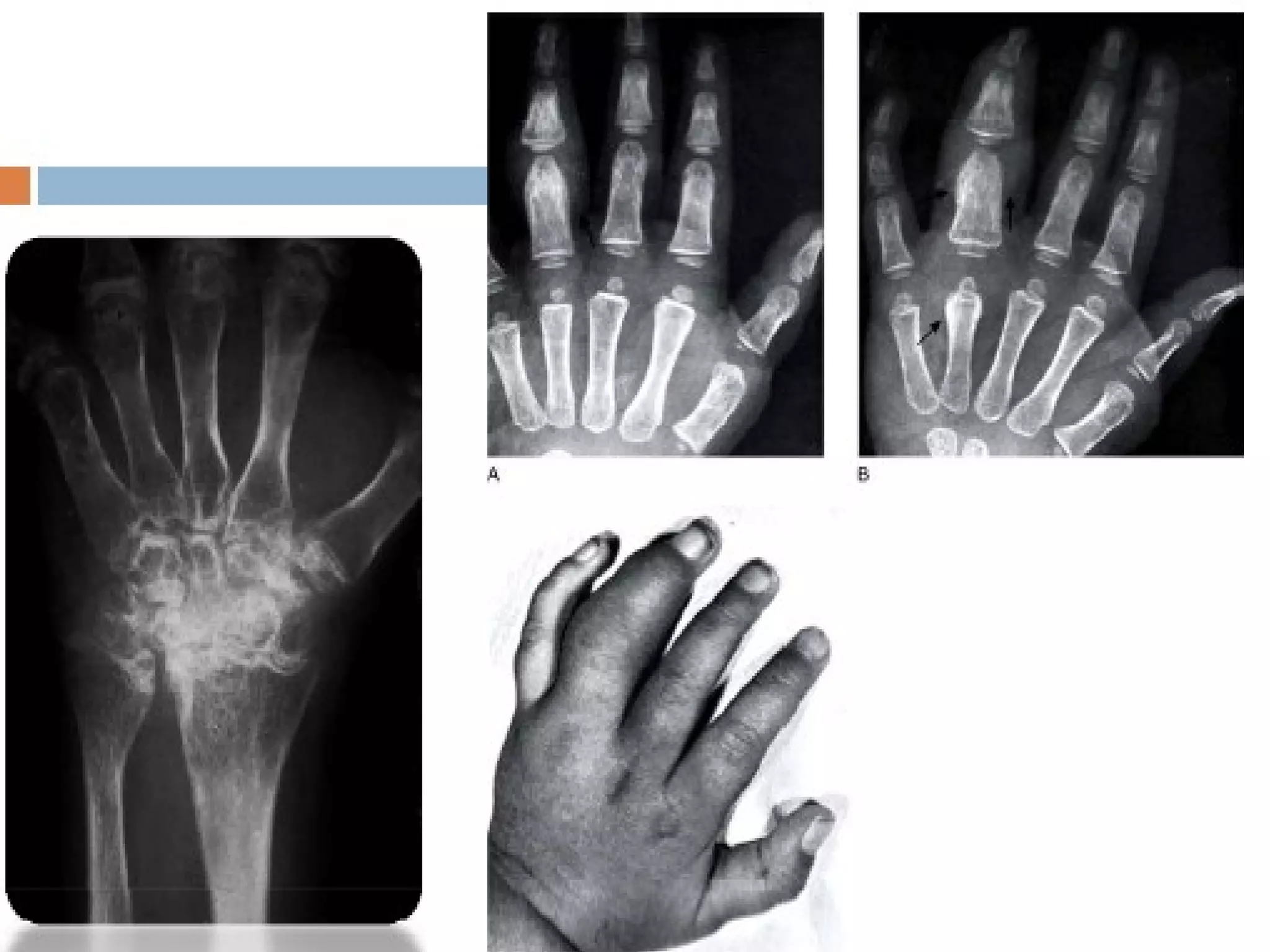 Arthrite juvenile ic PPT