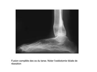 Fusion complète des os du tarse. Noter l’ostéotomie tibiale de
réaxation
 