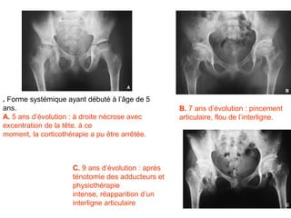 . Forme systémique ayant débuté à l’âge de 5
ans.                                                B. 7 ans d’évolution : pincement
A. 5 ans d’évolution : à droite nécrose avec        articulaire, flou de l’interligne.
excentration de la tête. à ce
moment, la corticothérapie a pu être arrêtée.



                     C. 9 ans d’évolution : après
                     ténotomie des adducteurs et
                     physiothérapie
                     intense, réapparition d’un
                     interligne articulaire
 