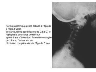 Forme systémique ayant débuté à l’âge de
6 mois. Fusion
des articulaires postérieures de C2 à C7 et
hypoplasie des corps vertébraux
après 5 ans d’évolution. Actuellement âgée
de 13 ans, l’enfant est en
rémission complète depuis l’âge de 5 ans
 
