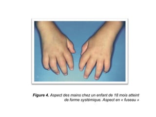 Figure 4. Aspect des mains chez un enfant de 18 mois atteint
                  de forme systémique. Aspect en « fuseau »
 