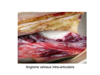 Angiome veineux intra-articulaire
 