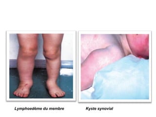 Lymphoedème du membre   Kyste synovial
 