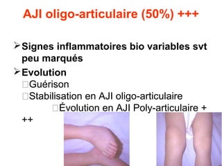 AJI oligo-articulaire (50%) +++

 Signes inflammatoires bio variables svt
  peu marqués
 Evolution
  �Guérison
  �Stabilisation en AJI oligo-articulaire
        �Évolution en AJI Poly-articulaire +
  ++
 