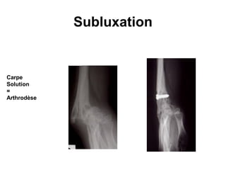 Subluxation


Carpe
Solution
=
Arthrodèse
 