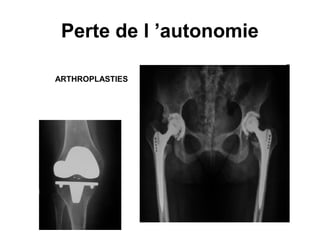 Perte de l ’autonomie

ARTHROPLASTIES
 