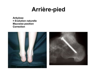 Arrière-pied
Ankylose
= Evolution naturelle
Mauvaise position
Correction
 