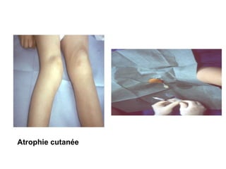 Atrophie cutanée
 
