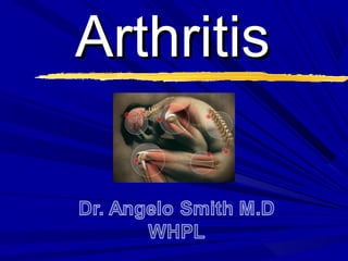 ArthritisArthritis
 