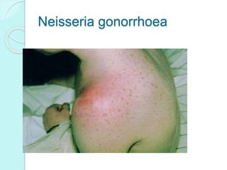 Neisseria gonorrhoea
 