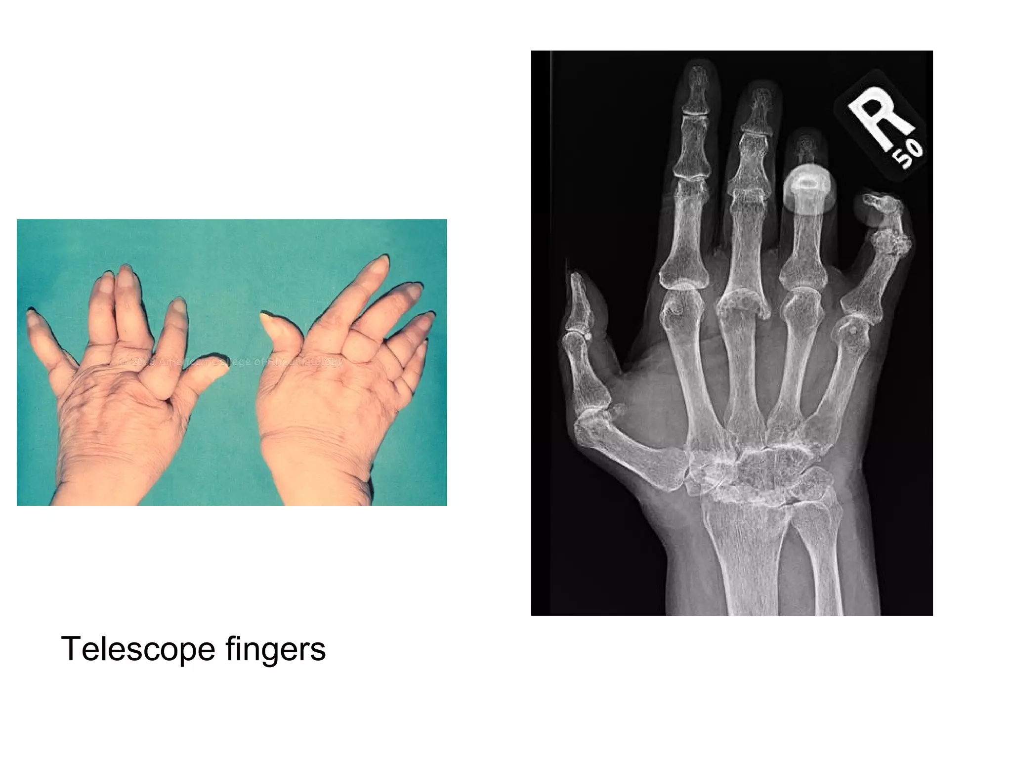 Telescope fingers
 