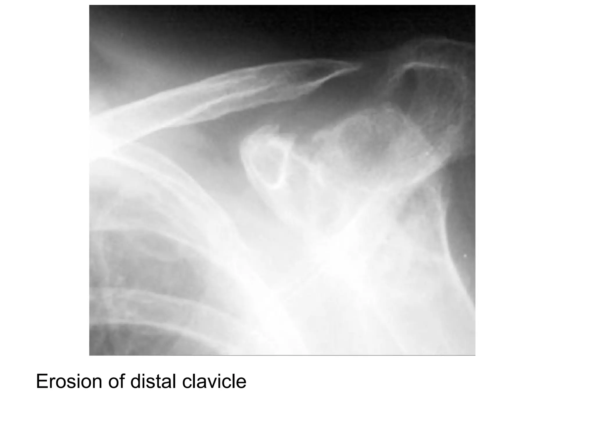 Erosion of distal clavicle
 