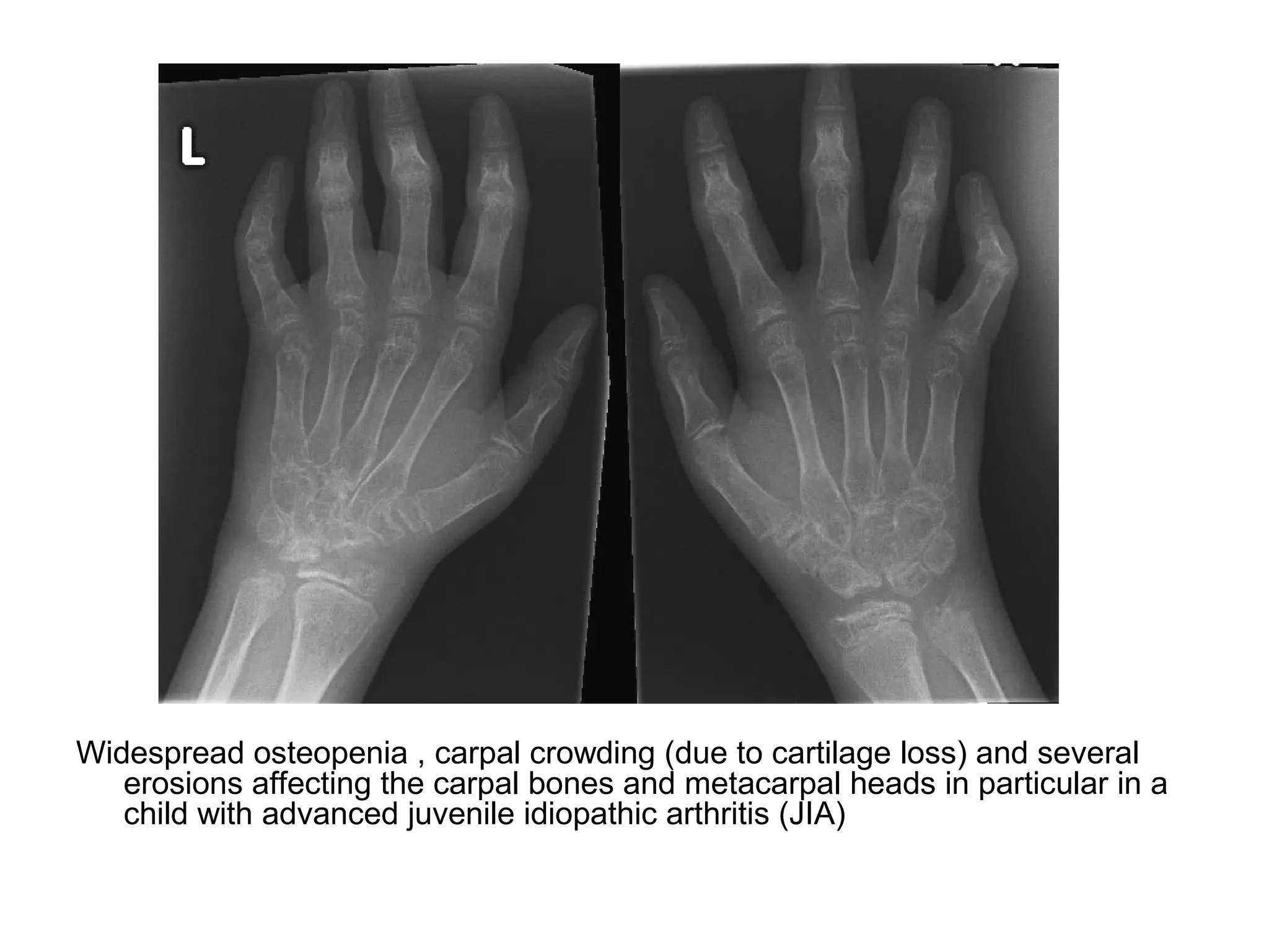 Widespread osteopenia , carpal crowding (due to cartilage loss) and several
erosions affecting the carpal bones and metacarpal heads in particular in a
child with advanced juvenile idiopathic arthritis (JIA)
 
