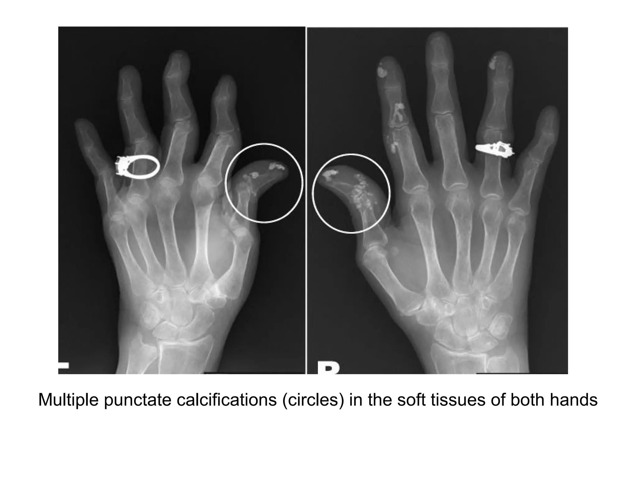 Multiple punctate calcifications (circles) in the soft tissues of both hands
 