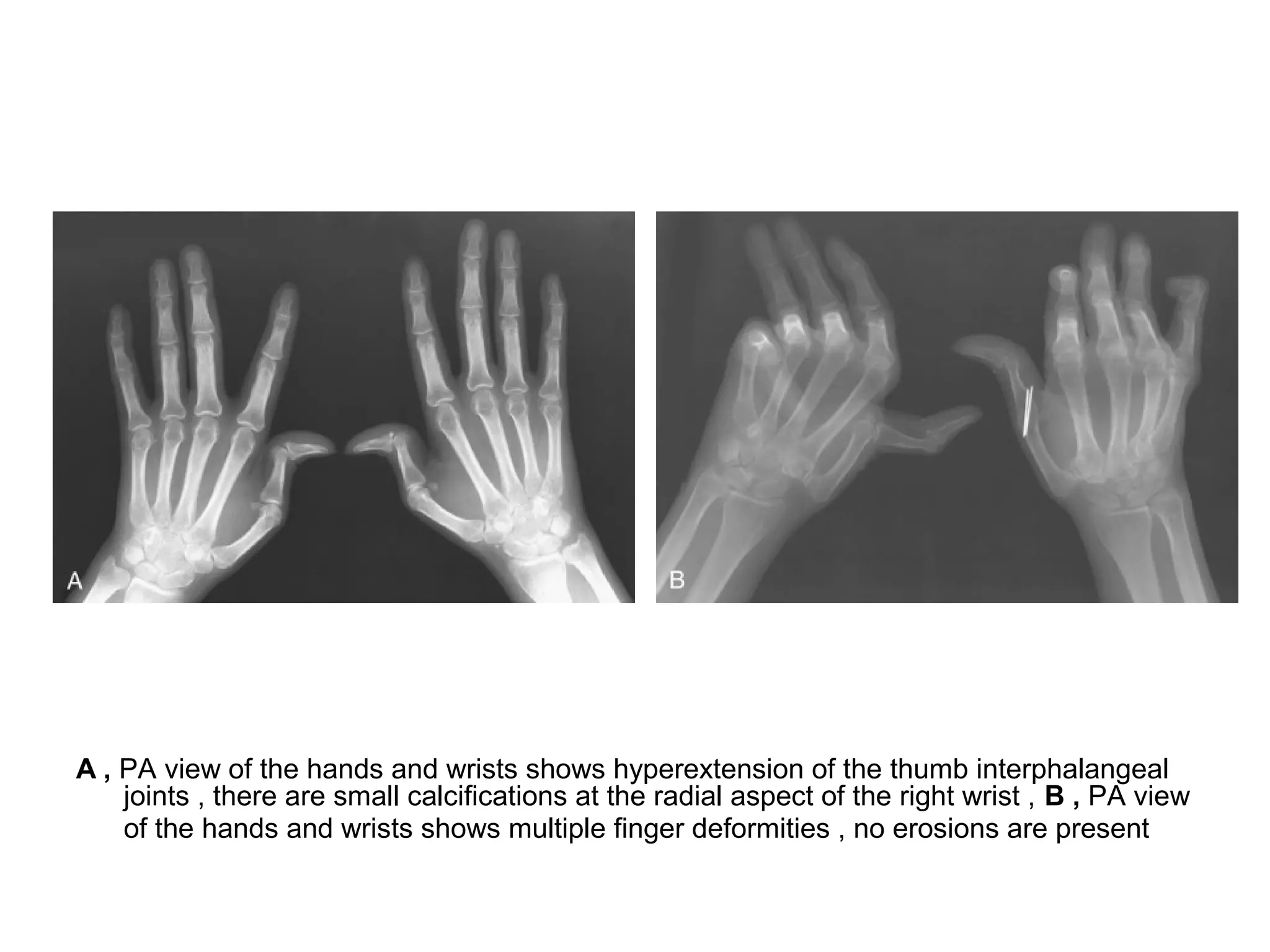 A , PA view of the hands and wrists shows hyperextension of the thumb interphalangeal
joints , there are small calcifications at the radial aspect of the right wrist , B , PA view
of the hands and wrists shows multiple finger deformities , no erosions are present
 