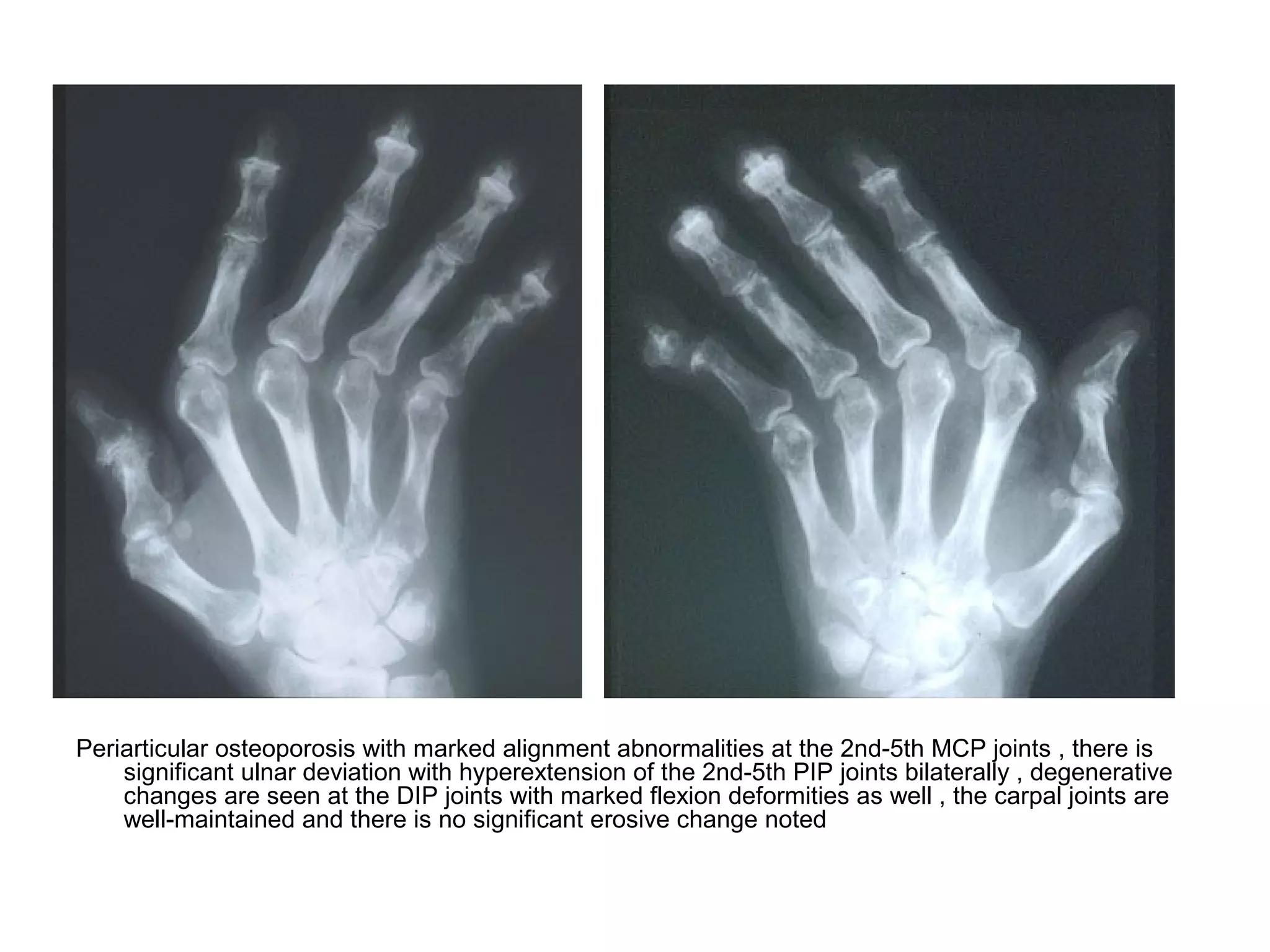 Periarticular osteoporosis with marked alignment abnormalities at the 2nd-5th MCP joints , there is
significant ulnar deviation with hyperextension of the 2nd-5th PIP joints bilaterally , degenerative
changes are seen at the DIP joints with marked flexion deformities as well , the carpal joints are
well-maintained and there is no significant erosive change noted
 