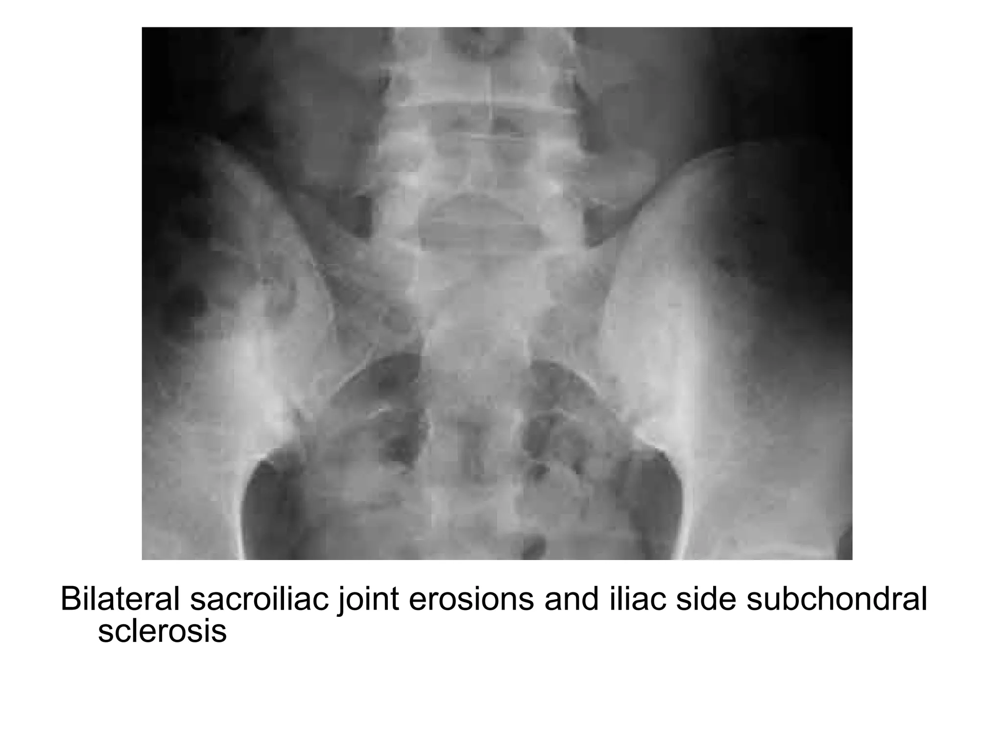 Bilateral sacroiliac joint erosions and iliac side subchondral
sclerosis
 