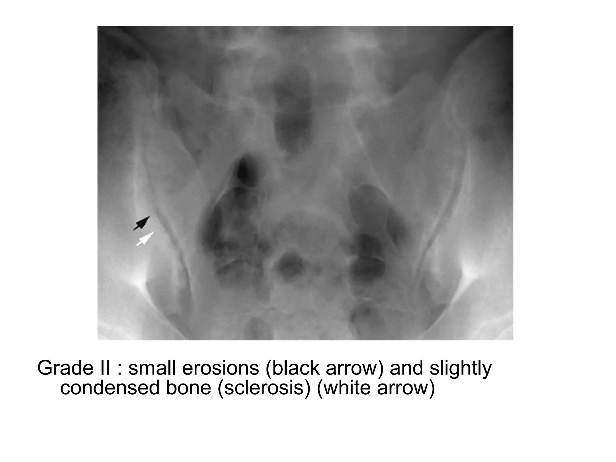 Grade II : small erosions (black arrow) and slightly
condensed bone (sclerosis) (white arrow)
 
