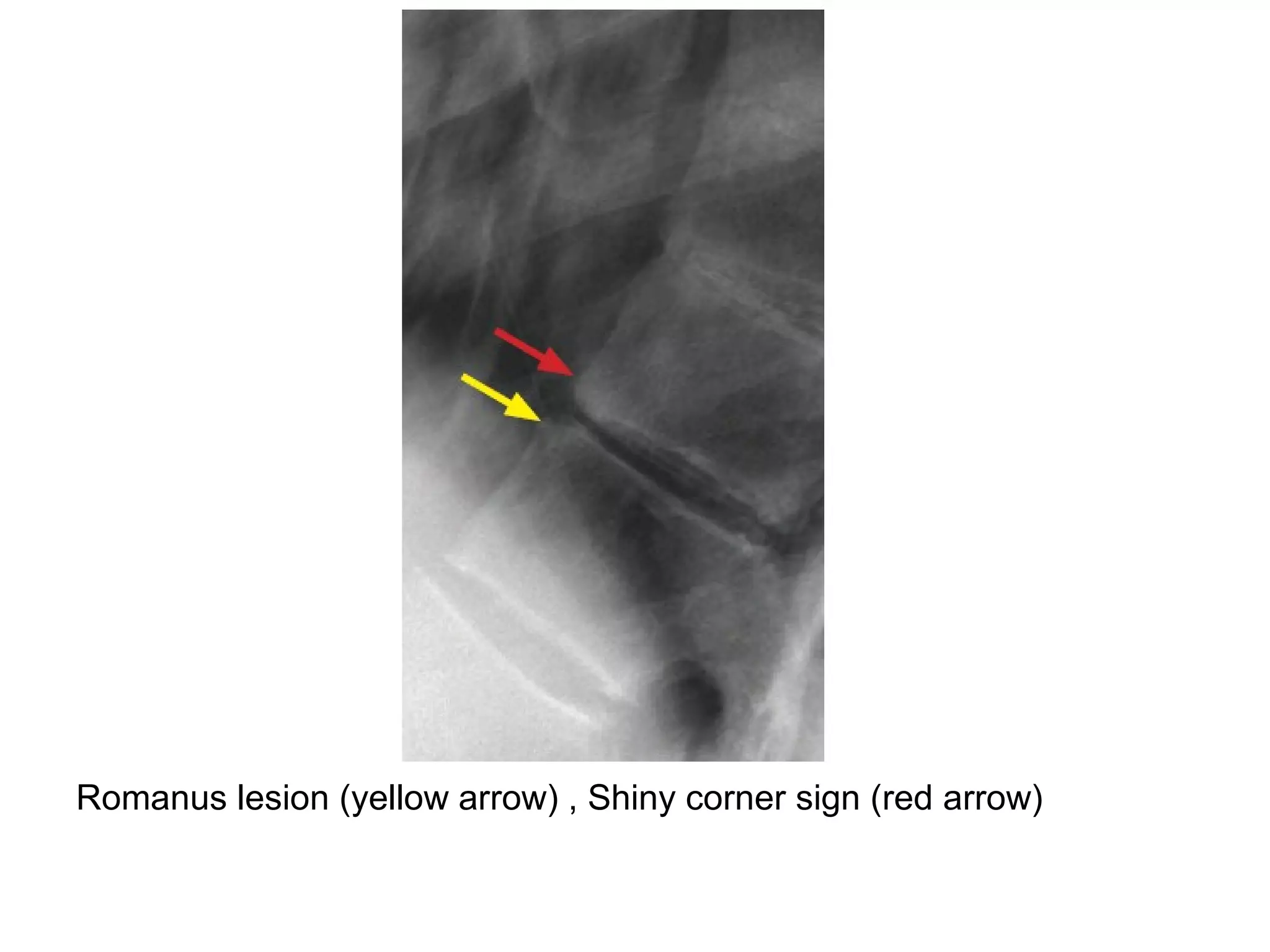 Romanus lesion (yellow arrow) , Shiny corner sign (red arrow)
 
