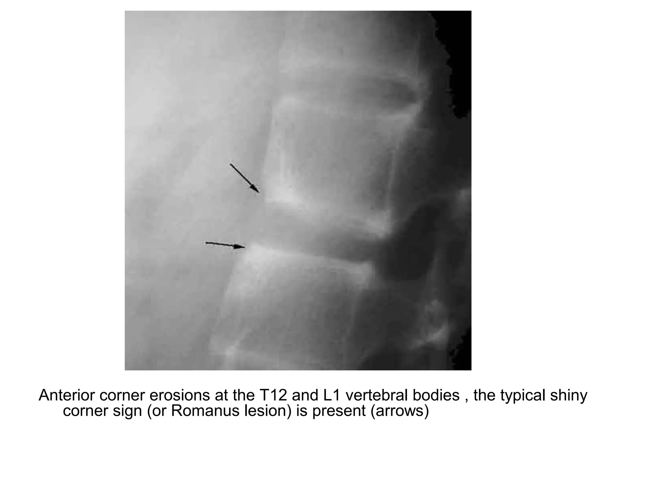 Anterior corner erosions at the T12 and L1 vertebral bodies , the typical shiny
corner sign (or Romanus lesion) is present (arrows)
 