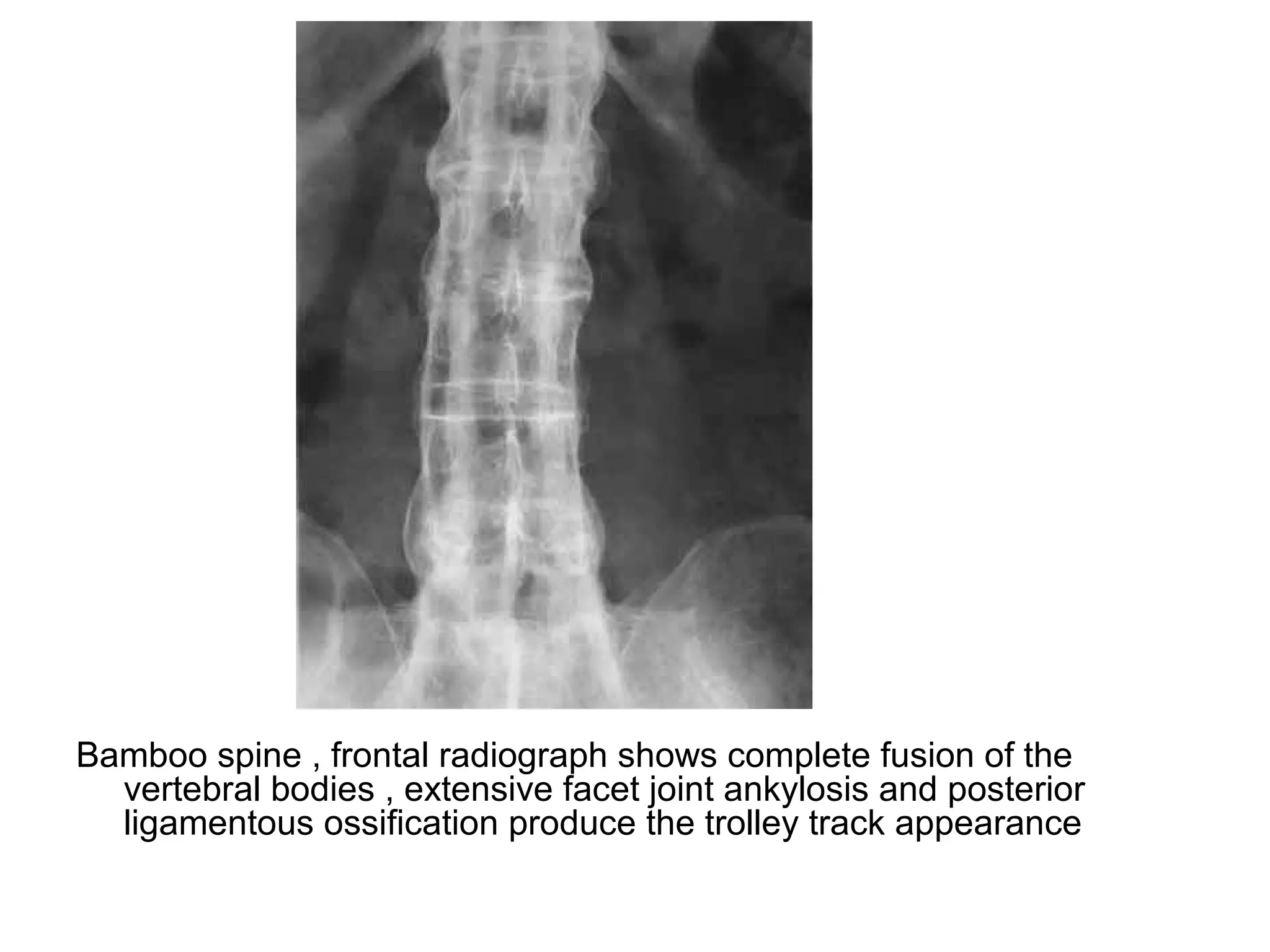 Bamboo spine , frontal radiograph shows complete fusion of the
vertebral bodies , extensive facet joint ankylosis and posterior
ligamentous ossification produce the trolley track appearance
 