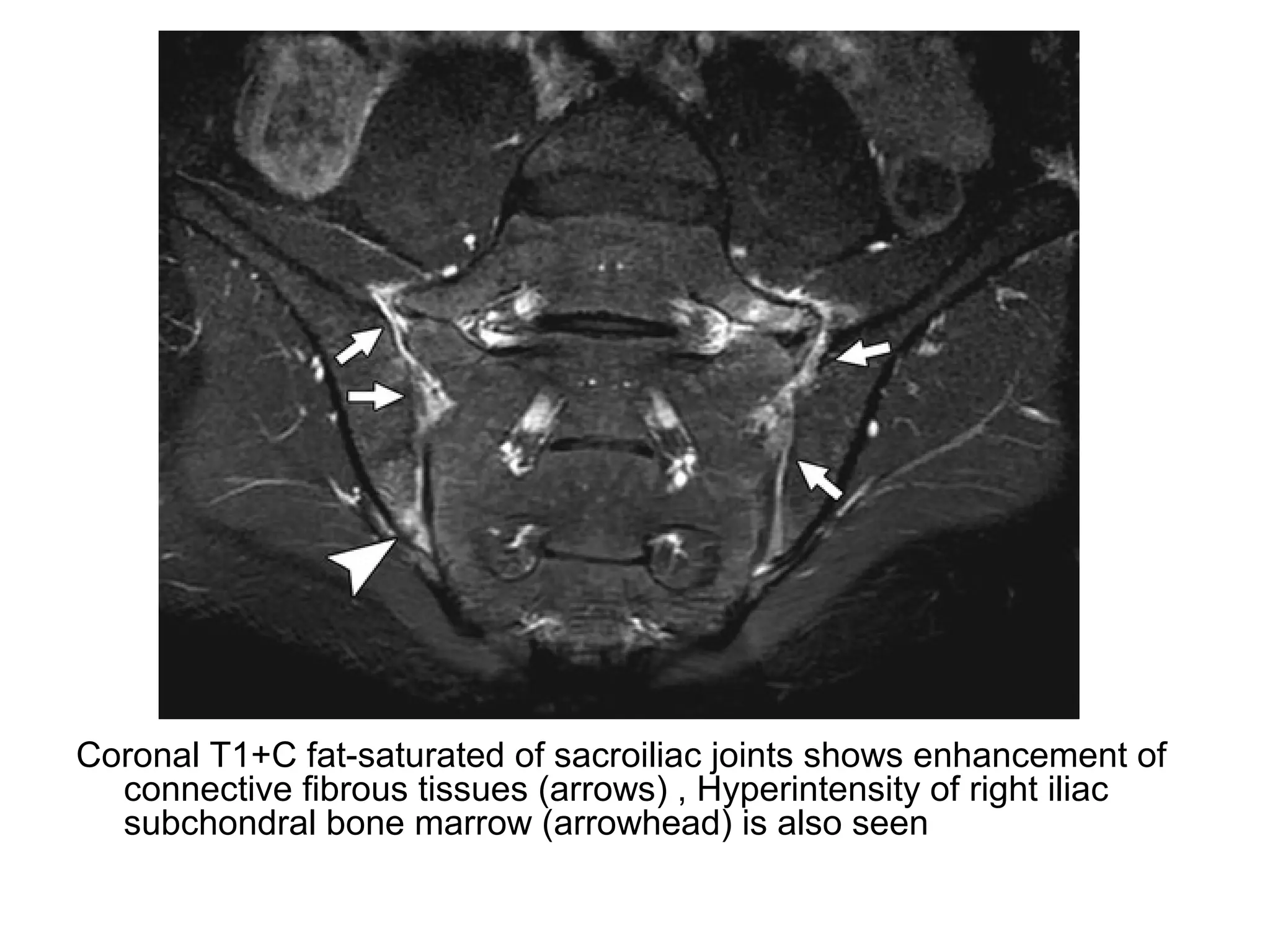 Coronal T1+C fat-saturated of sacroiliac joints shows enhancement of
connective fibrous tissues (arrows) , Hyperintensity of right iliac
subchondral bone marrow (arrowhead) is also seen
 