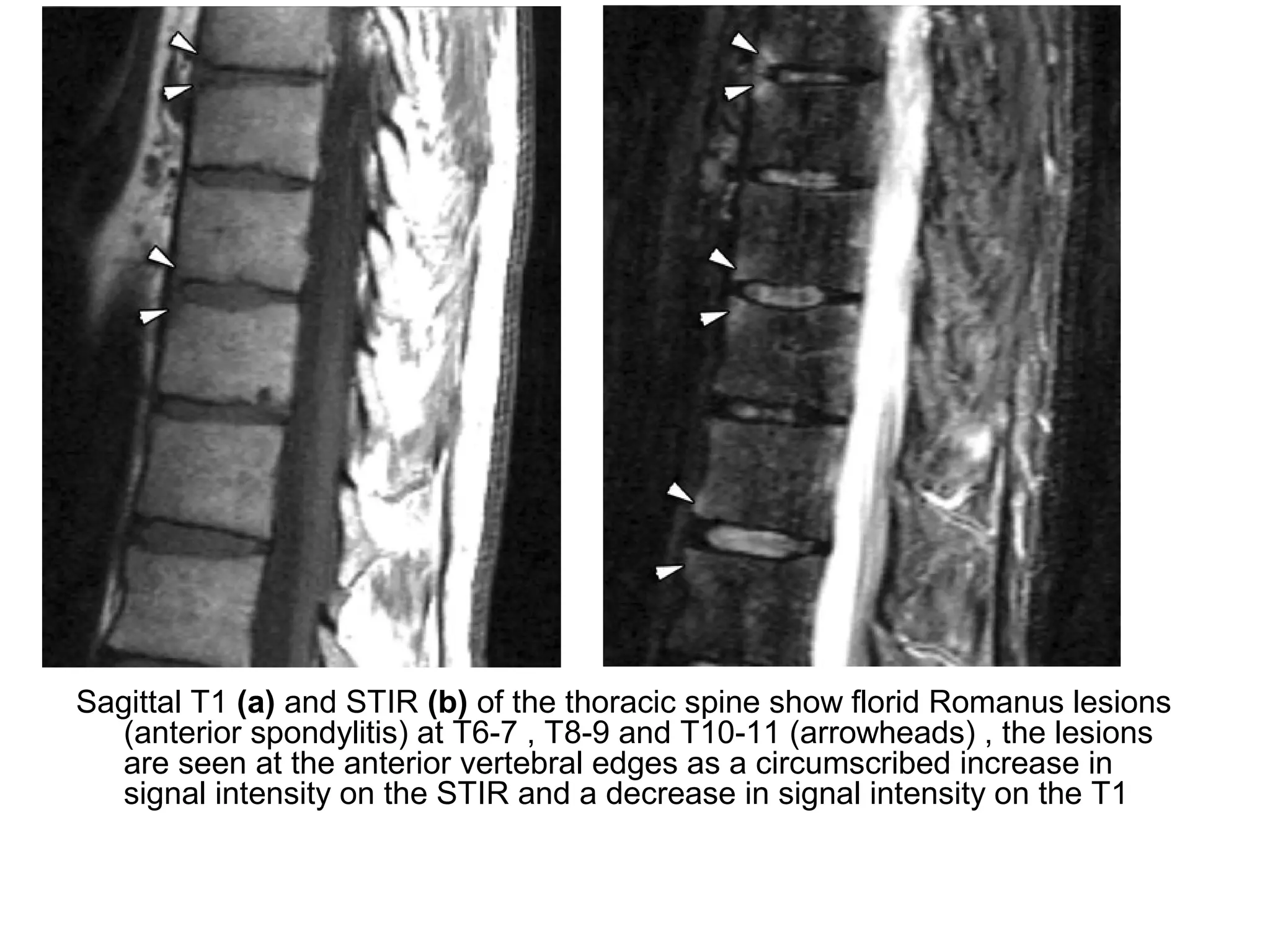 Sagittal T1 (a) and STIR (b) of the thoracic spine show florid Romanus lesions
(anterior spondylitis) at T6-7 , T8-9 and T10-11 (arrowheads) , the lesions
are seen at the anterior vertebral edges as a circumscribed increase in
signal intensity on the STIR and a decrease in signal intensity on the T1
 