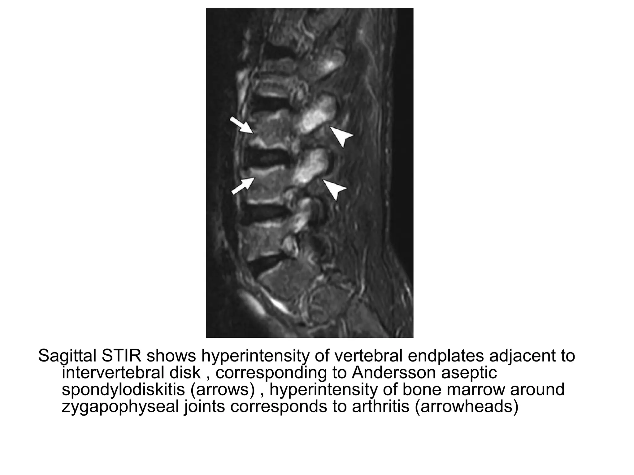 Sagittal STIR shows hyperintensity of vertebral endplates adjacent to
intervertebral disk , corresponding to Andersson aseptic
spondylodiskitis (arrows) , hyperintensity of bone marrow around
zygapophyseal joints corresponds to arthritis (arrowheads)
 