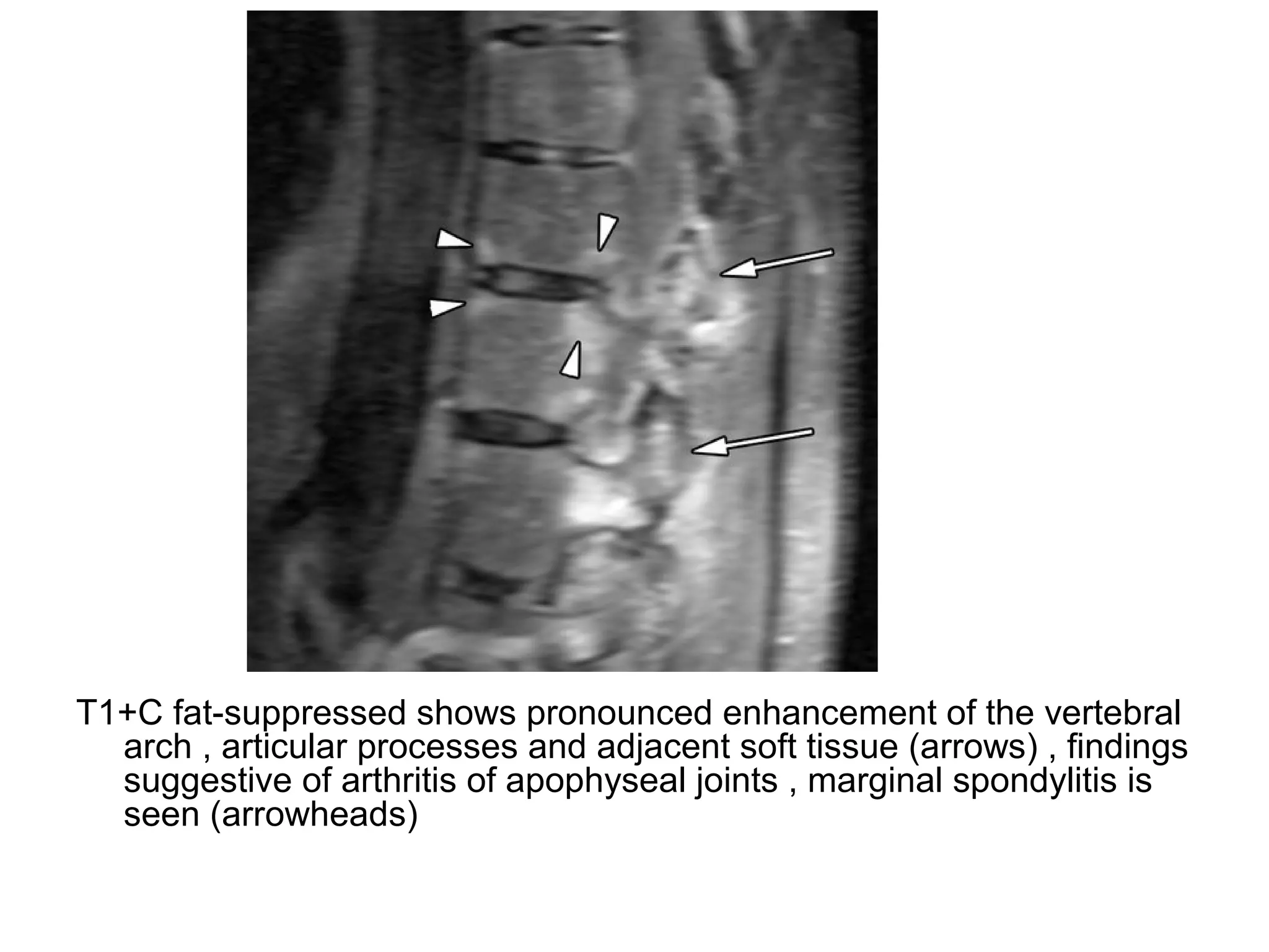 T1+C fat-suppressed shows pronounced enhancement of the vertebral
arch , articular processes and adjacent soft tissue (arrows) , findings
suggestive of arthritis of apophyseal joints , marginal spondylitis is
seen (arrowheads)
 