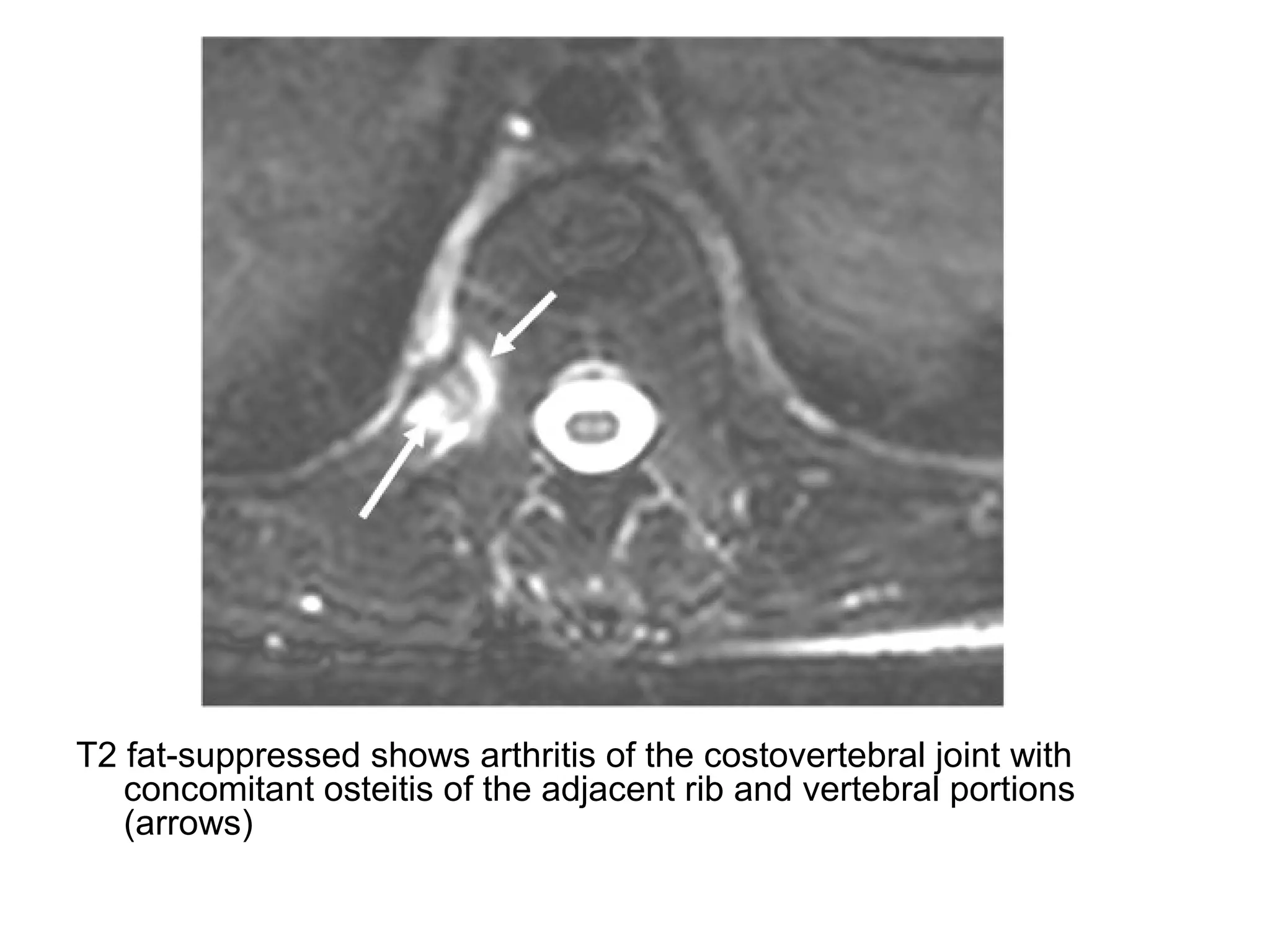 T2 fat-suppressed shows arthritis of the costovertebral joint with
concomitant osteitis of the adjacent rib and vertebral portions
(arrows)
 