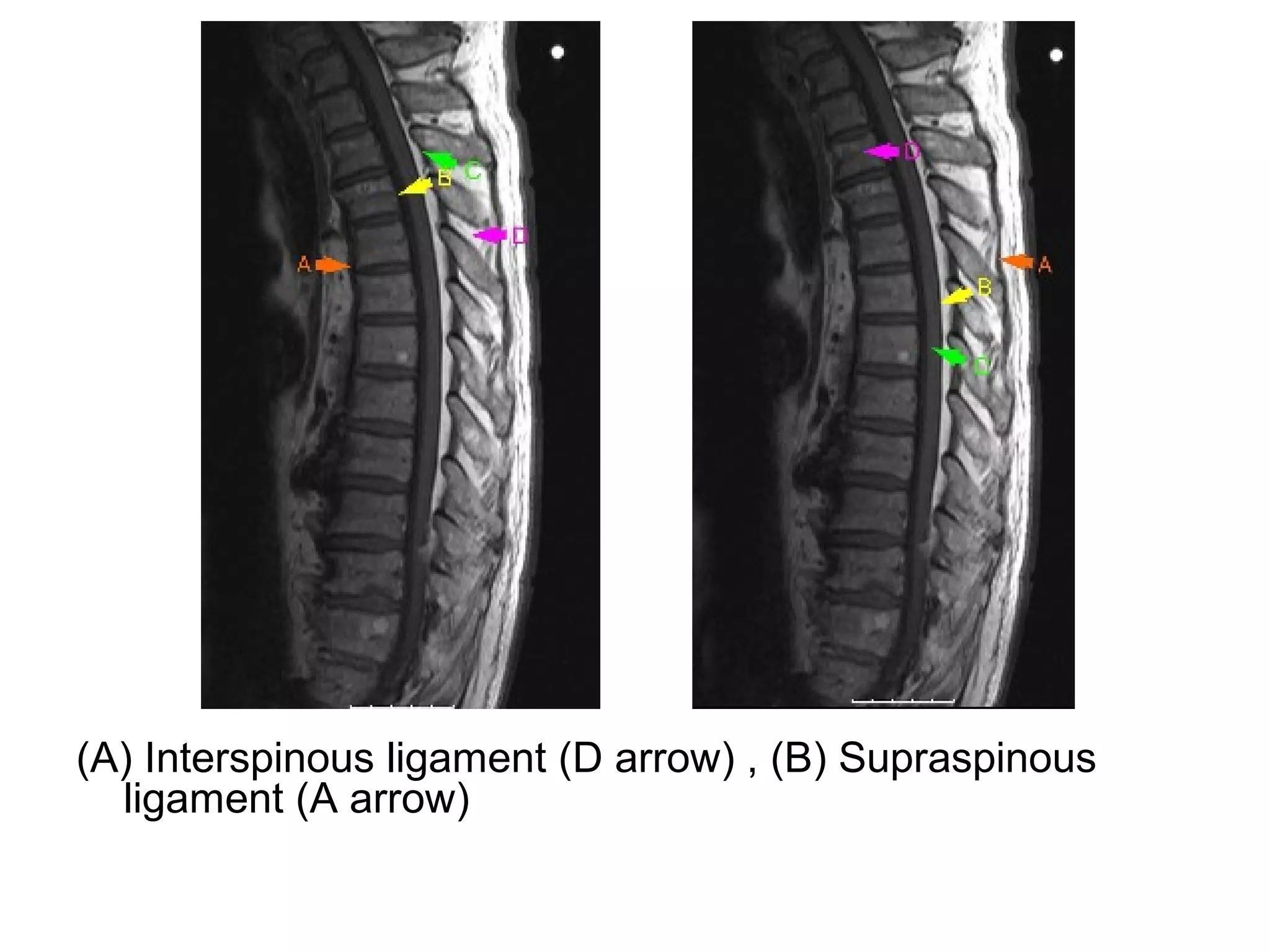 (A) Interspinous ligament (D arrow) , (B) Supraspinous
ligament (A arrow)
 
